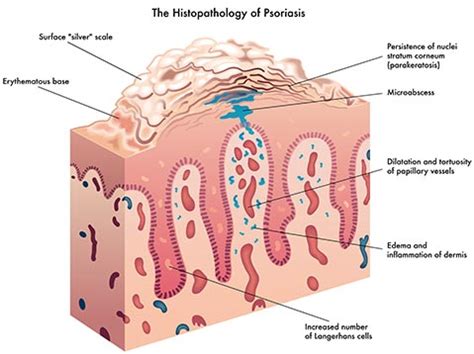 Psoriasis Specialists in NYC | Manhattan Dermatology