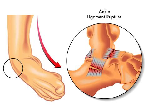 Lateral Ankle Sprain Mechanism Of Injury