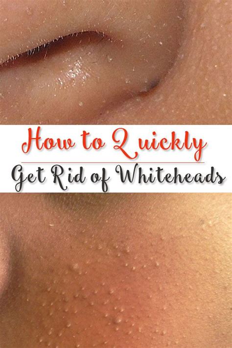 How to Quickly Get Rid of Whiteheads - Your Beauty Architect | Face ...