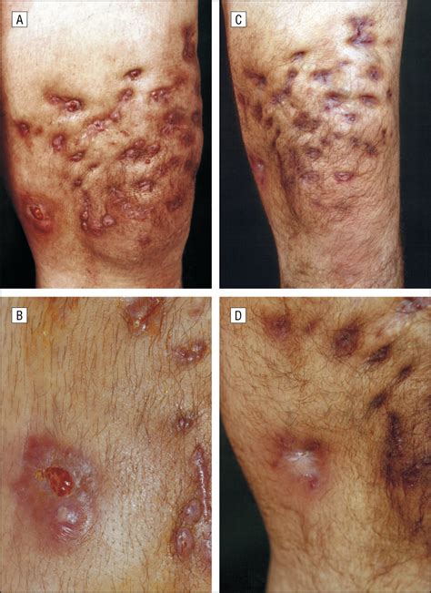 Nocardia otitidiscaviarum: Cause of Long-term Cutaneous Abscesses on the Leg of an ...