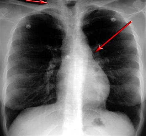 RadiologySpirit: bronchial asthma