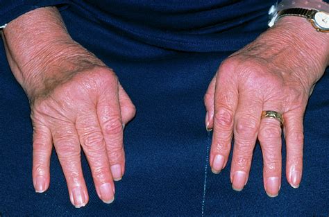 Arthritis Swelling Fingers at John Parsons blog