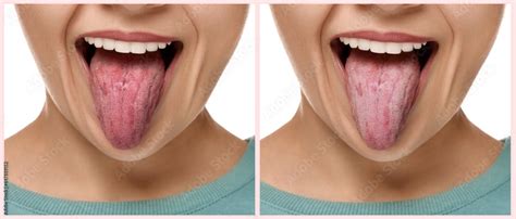 Collage with photos of woman before and after tongue cleaning on white background, closeup Stock ...