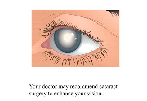 PatEdu.com : Cataract Surgery