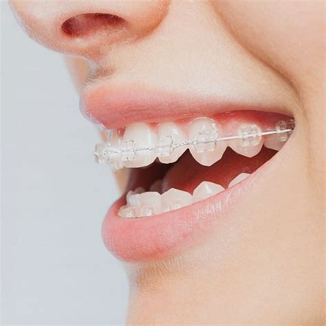 3 Things To Know About Removing Teeth For Braces