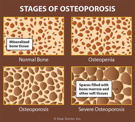 Stages Of Osteoporosis