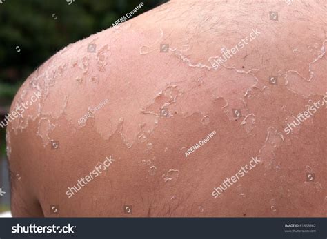 Close Detail Very Bad Sunburn Showing Stock Photo 61853362 - Shutterstock