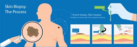 Skin Cancer Biopsy | Skin Screen Skin Cancer Clinic | Belmont Geelong