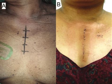 (A) Incision planning for partial sternotomy approach; (B ...