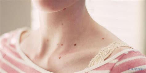 A lot of Red Spots on Skin: Should You Be Worried? - Step To Health