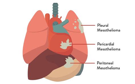 Prognosis Mesothelioma Pleural / Malignant Pleural Mesothelioma