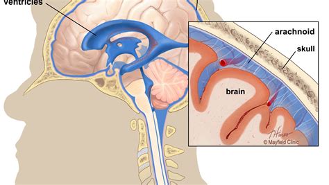 Ohio State's Urban Meyer has one, so what is an arachnoid cyst?