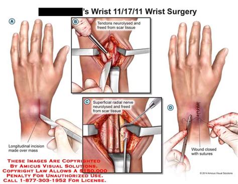 AMICUS Illustration of amicus,surgery,wrist,longitudinal,incision,mass,tendons,neurolysed,scar ...