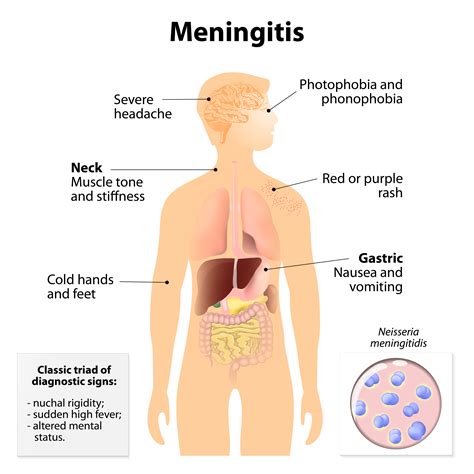 Meningitis - First Aid Wiki