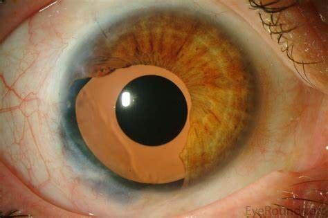 Important Things to Avoid after an Ocular Prosthesis Surgery | by ...