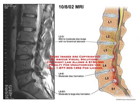 L5 herniation mri | Bulging disc, Mri, Disk herniation