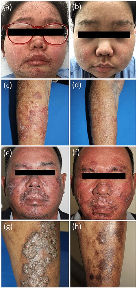 Acute cutaneous lupus erythematosus (ACLE) a resolving with ...