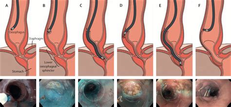 Submucosal surgery: novel interventions in the third space - The Lancet Gastroenterology ...