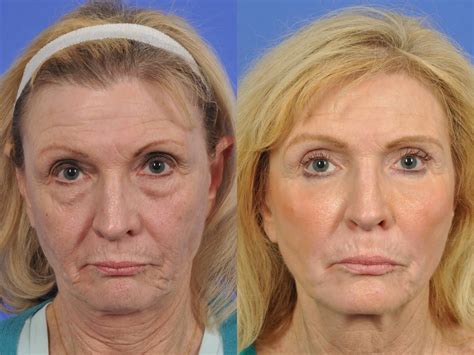 Facial Plastic Surgery | Philadelphia, PA | Dr. Allan Wulc