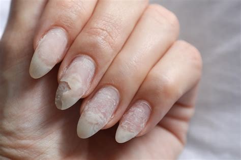 Premium Photo | Damaged nails after gel polish. close up.