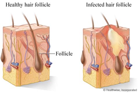 Bacterial Folliculitis Groin