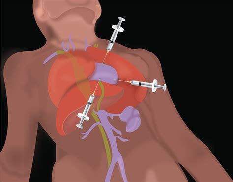 Sonoguide // Pericardiocentesis