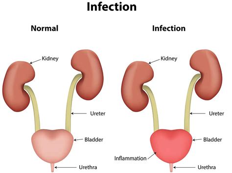 Urinary Tract Infections (UTI) Melbourne | North Eastern Urology