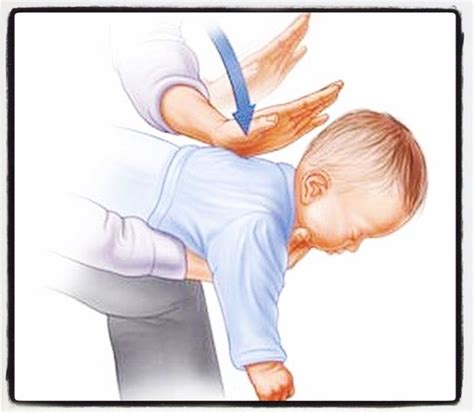 Pin by Shorena Gudushauri on Medical: Child | Heimlich maneuver, Baby ...