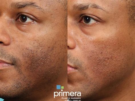 Skin Discoloration Treatment Before and After Photo Gallery | Orlando, Florida | Primera Plastic ...