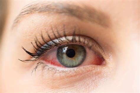 Are Your Red Eyes Allergies or Coronavirus?: Scott Beeve, M.D., FACS: Ophthalmologist