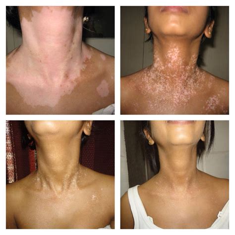 Case of Active Vitiligo - Maharshi Vitiligo Centres | India's Largest ...