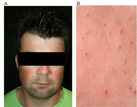 Clinical features of nevoid basal cell carcinoma syndrome. A. Facial... | Download Scientific ...