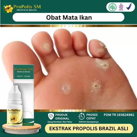 Obat Mata Ikan Di Telapak Kaki Dan Tangan, Obat Herbal Perontok Mata ...