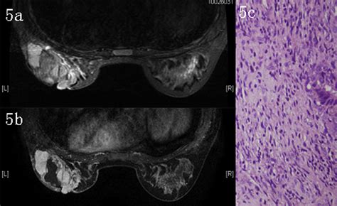 Imaging findings in phyllodes tumors of the breast - European Journal of Radiology