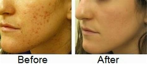 Health Care Tips: Know How to Remove Acne Scars – Get Rid of Pimple ...