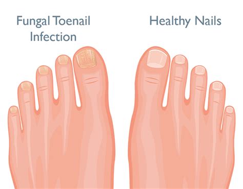 5 Healthy Habits to Prevent Toenail Fungus: Paul Betschart, DPM: Podiatrist