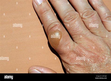 Large blister on woman’s hand caused by boiling water scald Stock Photo ...