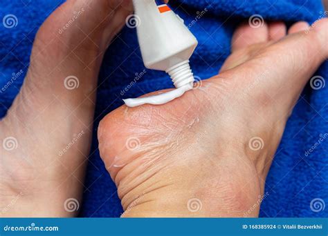 Applying Cream from the Tube on the Feet Sole for the Treatment of Corn, Callus, Callosity ...