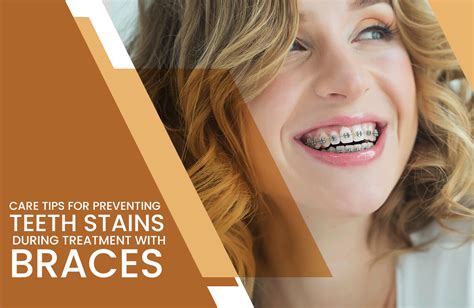 Tips To Prevent Teeth Stains During Treatment With Braces