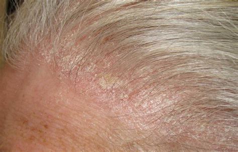 Red Spots On Scalp Pictures Causes And Treatments | Porn Sex Picture