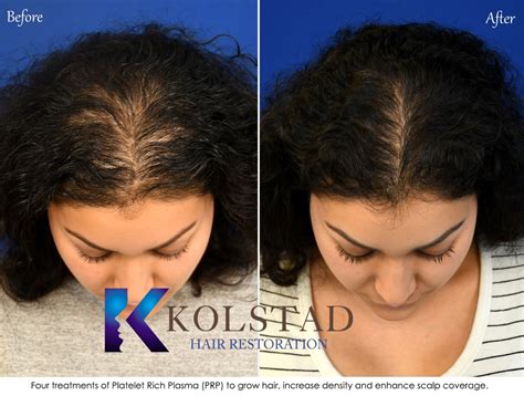 PRP Hair Treatment | Kolstad Hair Restoration