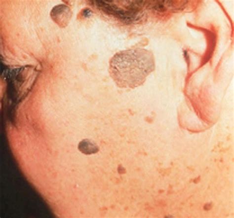 Can seborrheic keratosis become cancerous