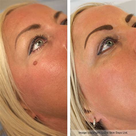 Mole removal: Should I have my mole removed? - Skin Surgery Clinic