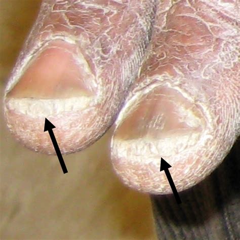 Psoriasis Nails Subungual Hyperkeratosis