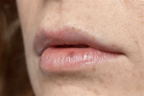 Lip Cancer: Causes, Symptoms & Prevention