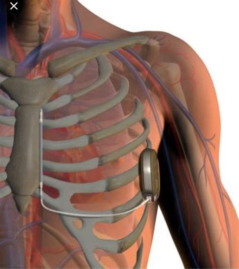 Automatic Implantable Cardioverter Defibrillators (AICD or ICD ...