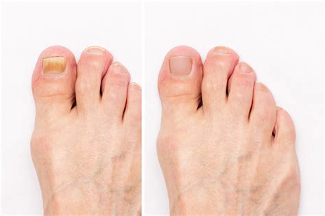 What are the Common Causes of Nail Fungus?