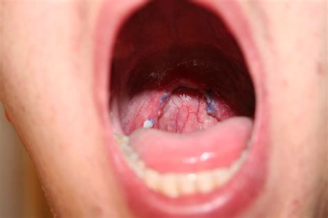 Throat after | After shot of throat, sans uvula. Sutures are… | Flickr