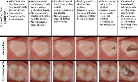 Carious lesion management in children and adolescents by Australian dentists - Keys - 2019 ...