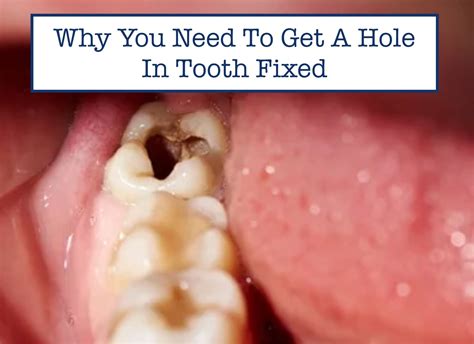 Why You Need To Get A Hole In Tooth Fixed